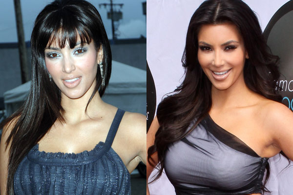 Kim Kardashian Plastic Surgery Procedures and Proof 