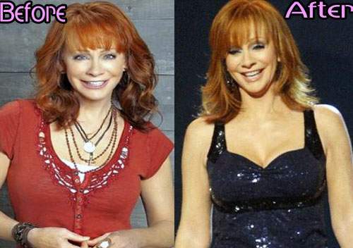 Reba McEntire Plastic Surgery Before And After Photos