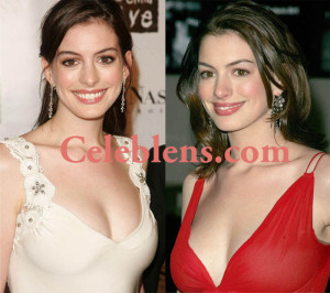 Anne Hathway Plastic Surgery Before After Photos