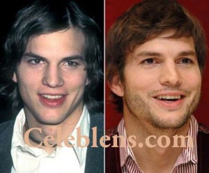 Aston Kutcher Plastic Surgery Before And After Photos