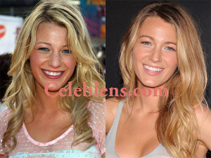 Blake Lively Plastic Surgery Before And After Photos