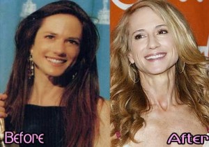 Holly Hunter Plastic Surgery Before And After Photos