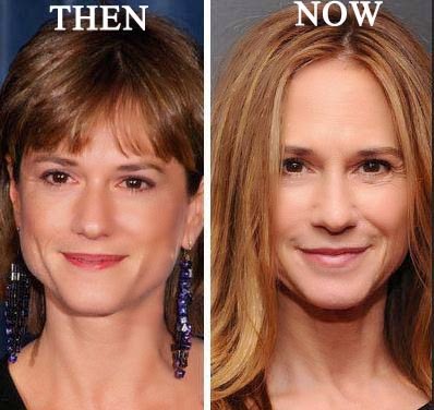 holly hunter plastic surgery botox treatment before after photos