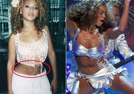 beyonce liposuction, beyonce abs reduction, beyonce fat reduction