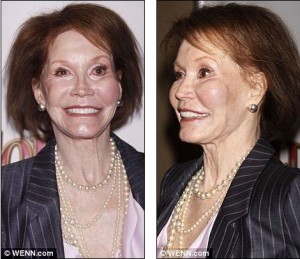 Mary Tyler Moore Plastic Surgery Before And After Photos