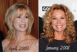 Kathie Lee Gifford Plastic Surgery Before And After Photos