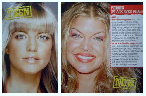 Fergie plastic surgery, Fergie plastic surgery before after photos, Fergie breast implants, Fergie breast augmentation, nose job, botox, Fergie photos, Fergie images, Fergie pictures3