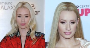 Iggy Azalea Plastic Surgery Before And After Photos