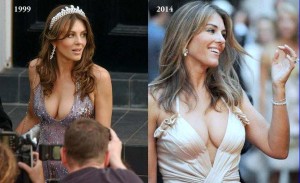 Elizabeth Hurley Plastic Surgery Before And After Photos