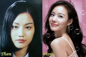 Best 5 Korean Plastic Surgery Before And After Photos