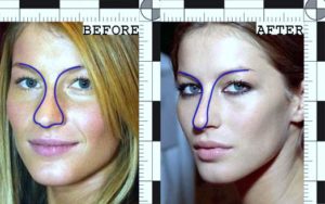Gisele Bündchen Plastic Surgery Before And After Photos