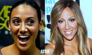 Melissa Gorga Plastic Surgery Before And After Photos