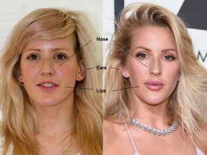 Ellie Goulding Plastic Surgery Before And After Photos