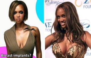 Tyra Banks Plastic Surgery Before And After Photos